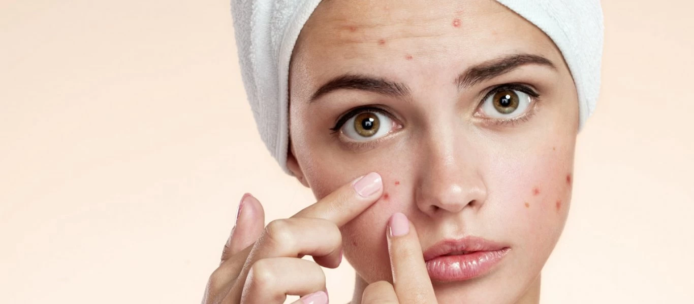 Ακμή: Αυτές είναι οι επτά τροφές που την προκαλούν